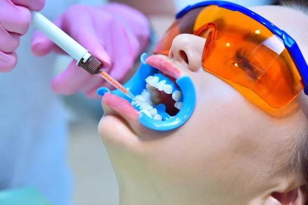 Dentista Aplica Gel Clareador Aos Dentes Paciente Clínica Odontológica Clareamento — Fotografia de Stock