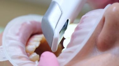 Klinikteki diş içi tarayıcı ile hastanın dişlerini tarayan ortodontiste yakın çekim. Sağlık ve Stomatoloji Konsepti. Yavaş Hareket Efekti.