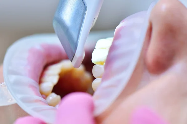 Primer Plano Del Dentista Haciendo Escaneo Los Dientes Los Pacientes — Foto de Stock