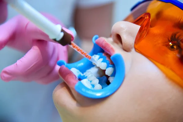 Primer Plano Del Dentista Aplica Gel Los Dientes Antes Blanquear —  Fotos de Stock