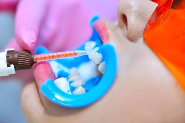 Kvinna Tandläkare Applicerar Gel Tänderna Innan Blekning Tänder Vacker Flicka — Stockfoto