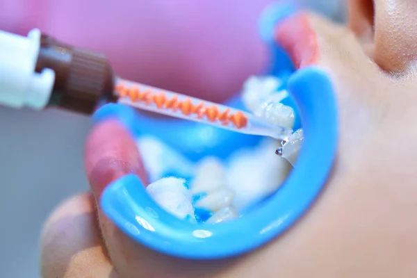 Stomatolog Applicerar Bleknings Gel Patienttänder Tandvårdskliniken Tandblekning Tandvårdsklinik Koncept Närbild — Stockfoto