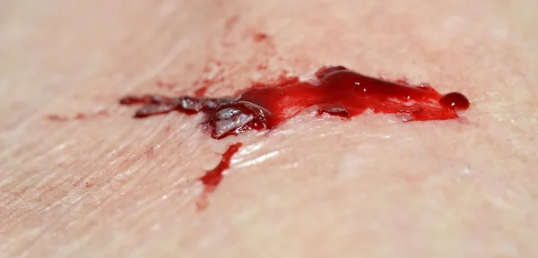 찢어진 및 출혈 피부 — 스톡 사진