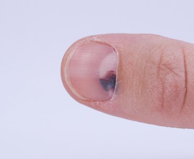 Subungual hematoma under nail clipart