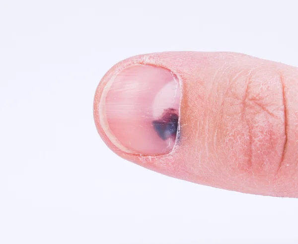 Subungual hematoma under nail — Stock Photo, Image