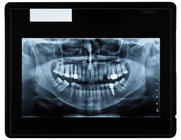 Orthopantomogramm Einzelbild Röntgenaufnahme Von Unterkiefer Oberkiefer Und Zähnen — Stockfoto