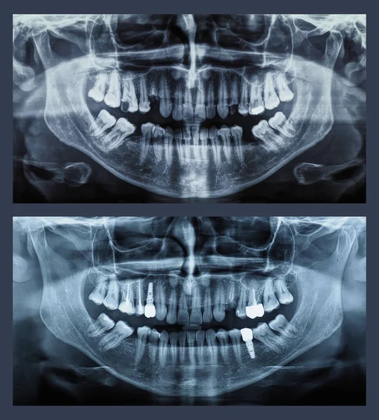 Orthopantomogram Single Panoramic Image Radiograph Mandible Maxilla Teeth Showing Comparison — Stok fotoğraf