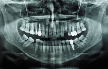 orthopantomogram tek panoramik görüntü çene, çene ve dişlerin radyografisi