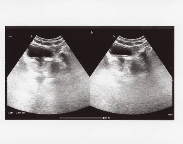 Повне Ультразвукове Зображення Живота Діагностична Сонограма — стокове фото