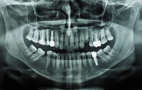 Orthopantomogram Single Panoramic Image Radiograph Mandible Maxilla Teeth — Stockfoto
