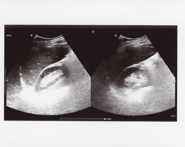 Full Abdomen Ultrasound Image Aka Diagnostic Sonogram — Photo