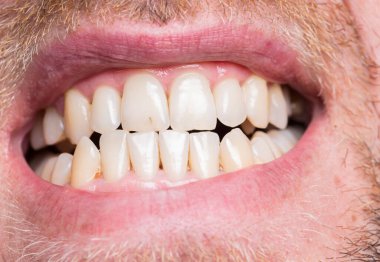 Sakallı bir adam beyaz dişlerini gösteriyor.