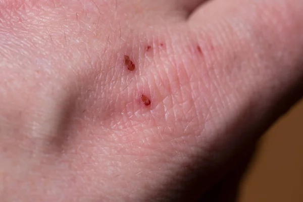 Wounds Human Skin Diseased Skin Macro — Stock Photo, Image