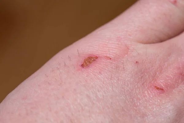 Wounds Human Skin Diseased Skin Macro — Stock Photo, Image