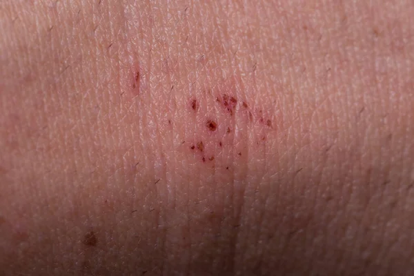 Heridas Piel Humana Piel Enferma Macro — Foto de Stock