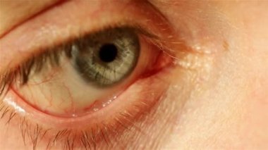 Hastalık kapandıktan sonra ince kırmızı kılcal damarlı insan gözü.