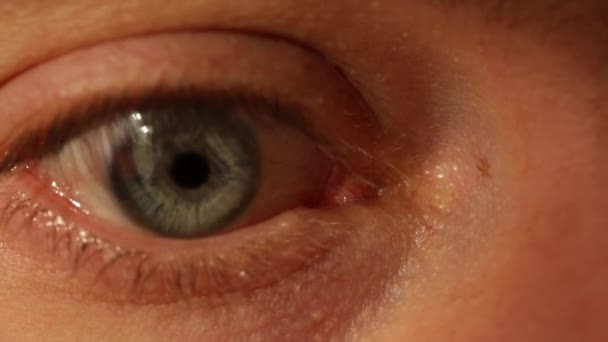 Человеческий Глаз Серый Много Красных Сосудов Крупным Планом — стоковое видео
