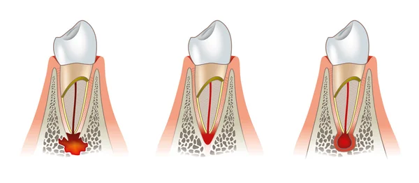 Захворювання зубів стоматологічна схема. Пародонтит — стокове фото