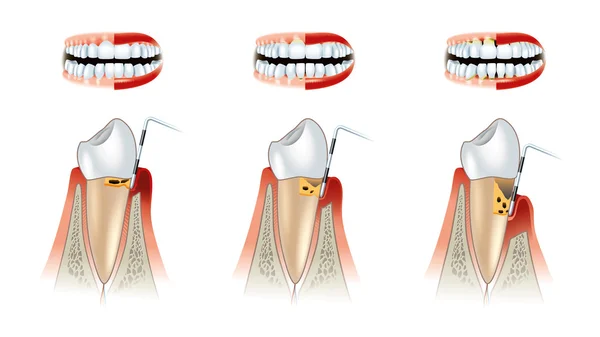 Malattie di schema dentale di denti. Alveolisi — Foto Stock