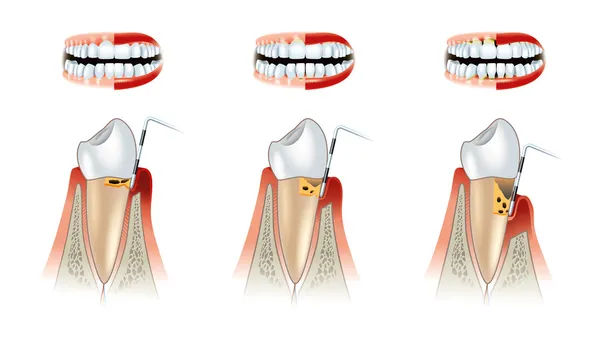 Ziekten van tanden tandheelkundige regeling. alveolysis — Stockfoto