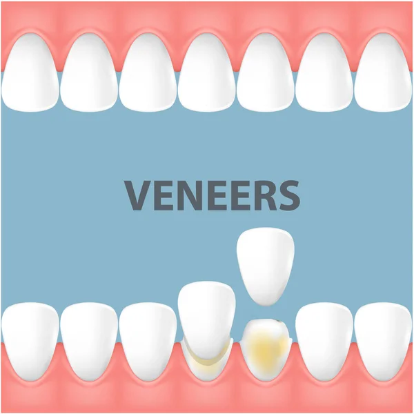 Dents Sourire Relooking Avec Placages Céramique Dentaire Rangée Dents Avant — Image vectorielle
