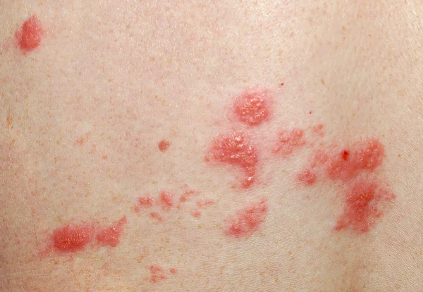 Shingles sores Stock Image