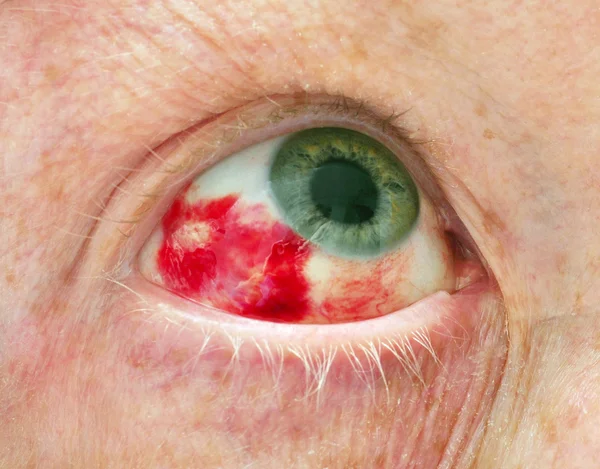 Hemorrhage in Eye — Stock Photo, Image