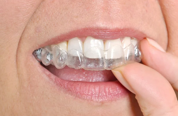 Invisible braces — Stock Photo, Image