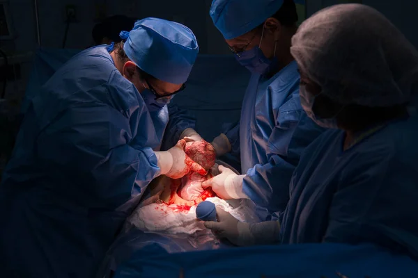 Cesarean Section Operation Process Child Closeup — Stockfoto