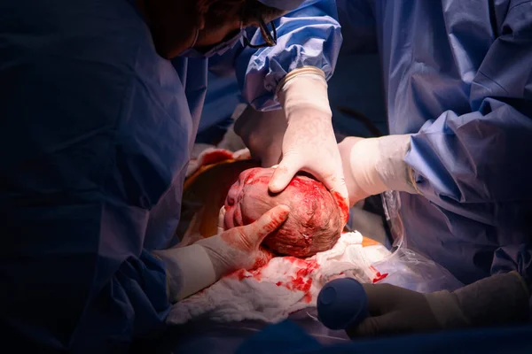 Cesarean Section Operation Process Child Closeup — Foto de Stock