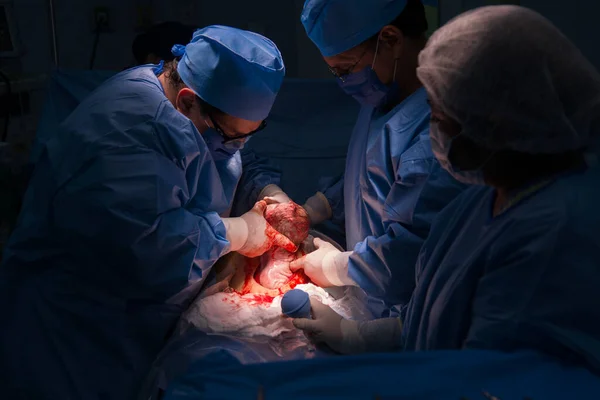 Cesarean Section Operation Process Child Closeup Stok Gambar Bebas Royalti
