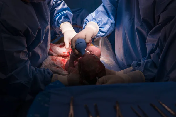Cesarean Section Operation Process Child Closeup — Zdjęcie stockowe