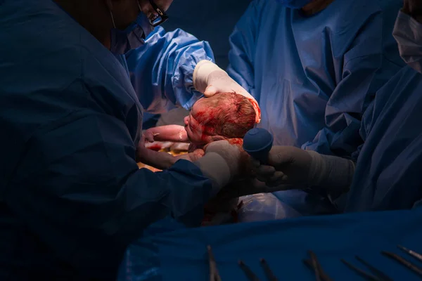 Cesarean Section Operation Process Child Closeup Stok Foto