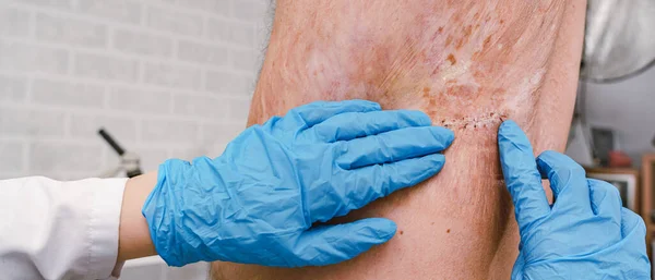 Doctor Treating Wound Burn Emergency Room Hospital Doctor Examines Patient — Stock Photo, Image