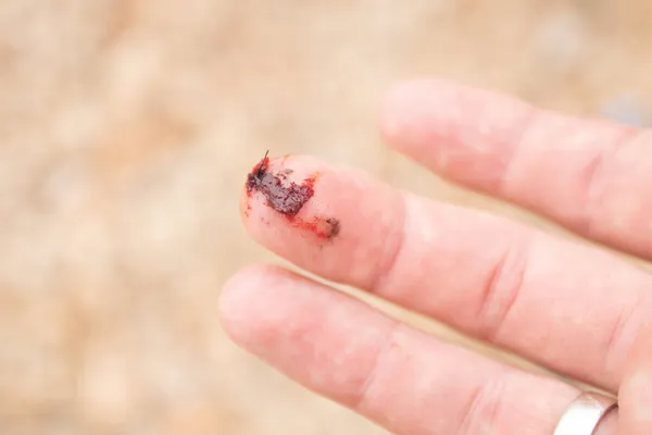 Dedo Ferido Com Sangramento Corte Aberto — Fotografia de Stock