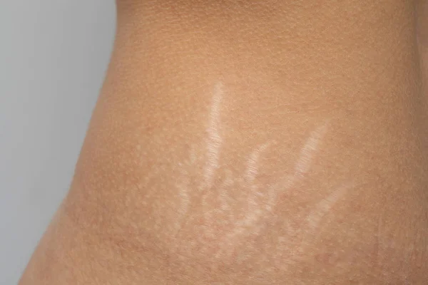 Kadın kalçalarının derilerinde gerilme izleri var.