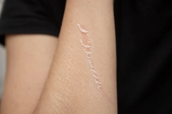 Abrasion Arm Scratched Skin Arm — Stock Photo, Image