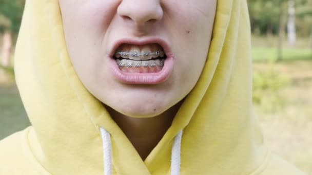 Крупный План Рот Девочки Подростка Металлическими Зубными Скобками — стоковое видео