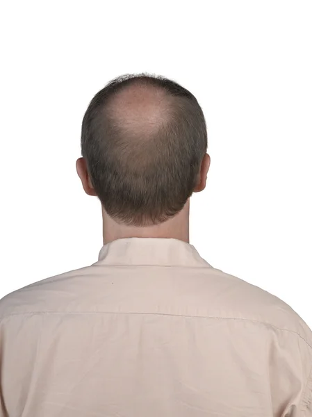 Human hair loss — Stock Photo, Image