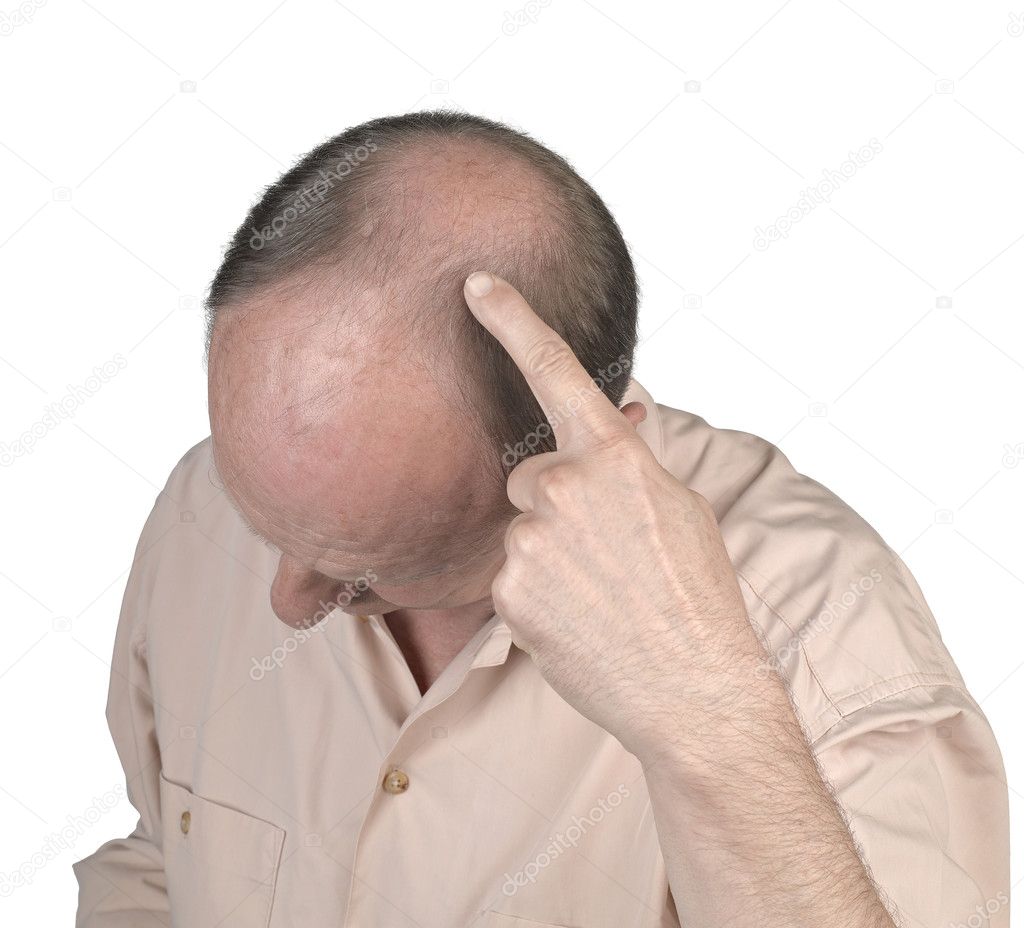 Human hair loss - adult man hand pointing his bald head
