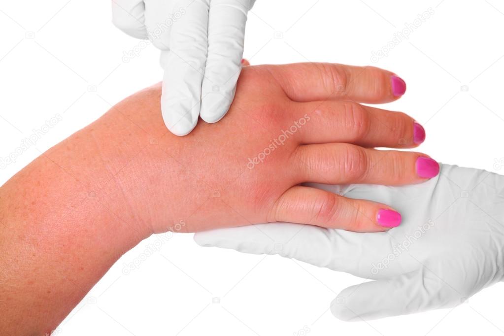 Mano hinchada fotografía de stock © macniak 12522376 Depositphotos