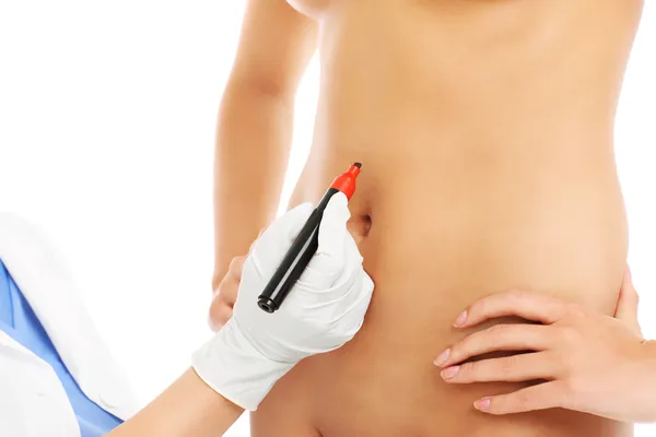 Médico marcando vientre para cirugía — Foto de Stock