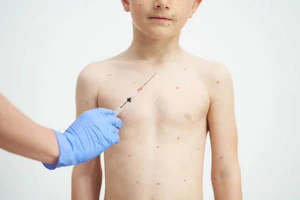 Young Boy Having Chickenpox Pictures Skin High Quality Photo — Stock Photo, Image