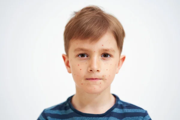 小男孩有水痘的皮肤图片 高质量的照片 — 图库照片