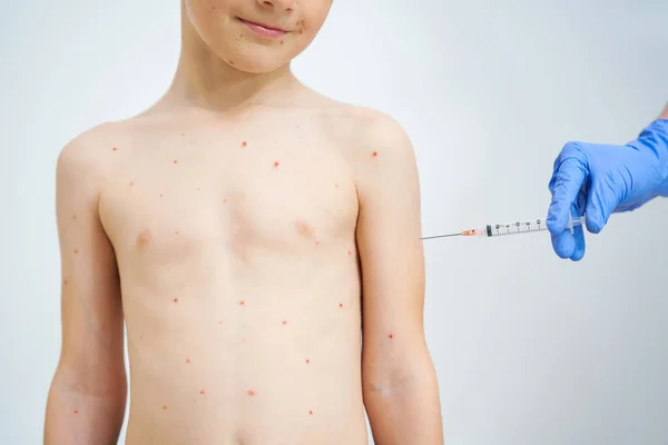 Young Boy Having Chickenpox Pictures Skin High Quality Photo — Stock Photo, Image