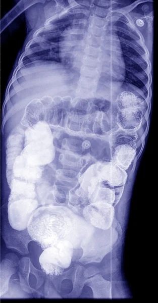 Рентген черевної порожнини — стокове фото