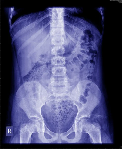 Röntgen des Bauches — Stockfoto
