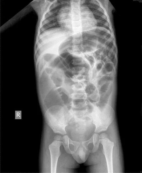 Рентген брюшной полости — стоковое фото