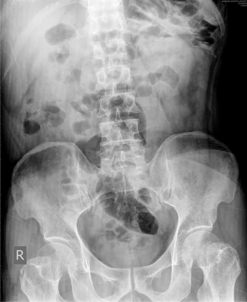 X-ray of the abdomen — Stock Photo, Image