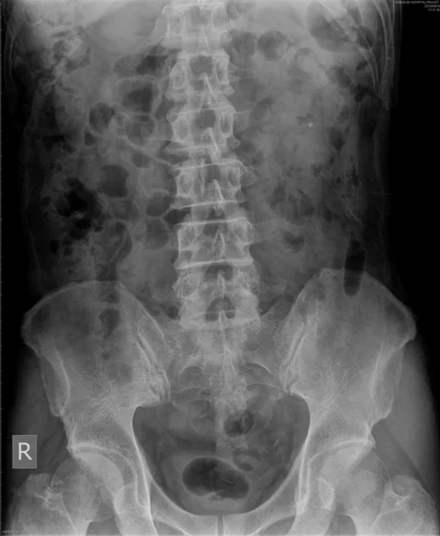 Röntgen av buken — Stockfoto